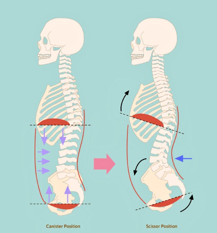 左为正确姿势: 自然脊椎曲线+肋骨与骨盆对齐+横膈膜与骨盆底对齐右为错误姿势: 刻意挺胸(俗称剪刀姿势scissor position)左为正确姿势: 自然脊椎曲线+肋骨与骨盆对齐+横膈膜与骨盆底对齐右为错误姿势: 刻意挺胸(俗称剪刀姿势scissor position)