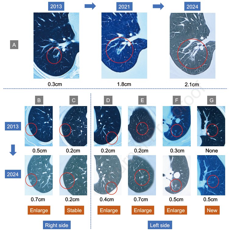 肺部多发磨玻璃结节，切还是不切？新研究给出“观察”选项随着高分辨率CT检查的普及，肺部被发现存在多个磨玻璃密度影（GGOs）的患者日益增多