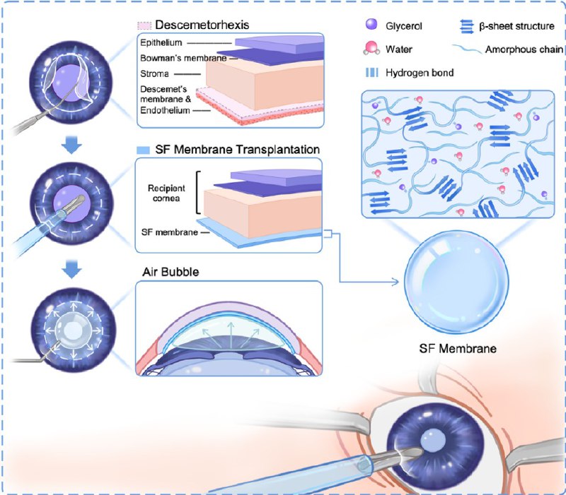 中国科学家用蚕丝开发出可降解人工角膜内皮！角膜内皮功能障碍是导致角膜盲的主要原因之一