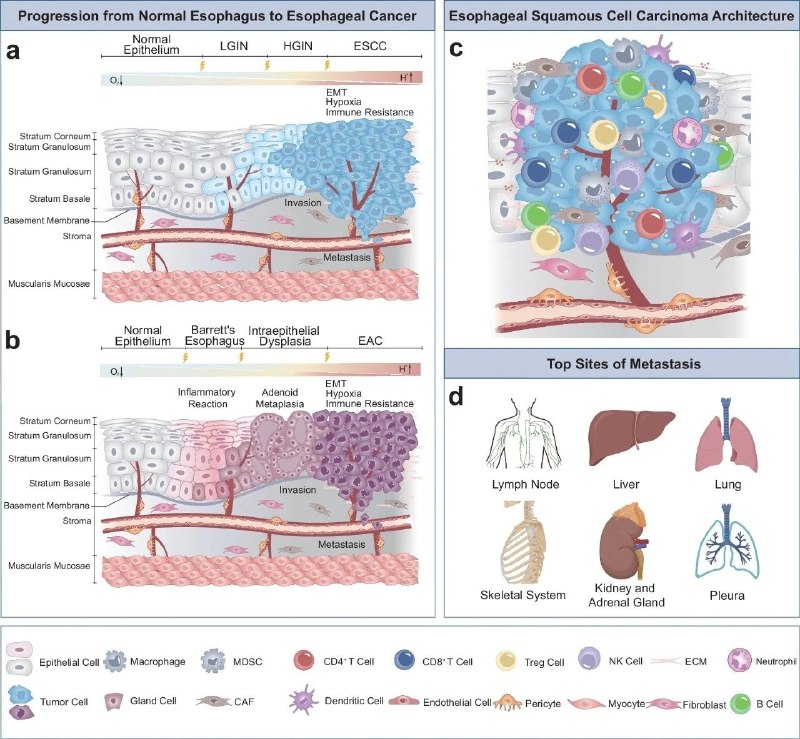 食管癌的分子机制与精准治疗新突破：从发病到治愈的路径探索食管癌是全球常见的恶性肿瘤，尤其在中国，其发病率和死亡率居高不下