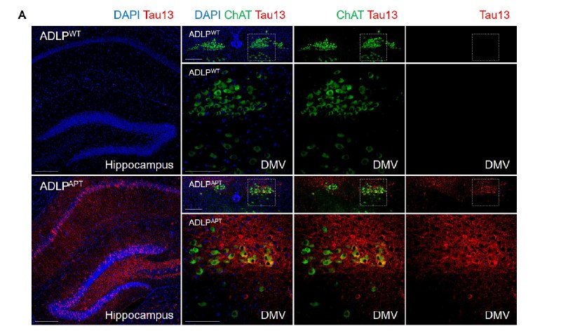 阿尔茨海默病“脑肠轴”新发现：致病蛋白可从大脑“旅行”至肠道近期，首尔大学Inhee Mook-Jung教授团队在《Gut》期刊发表研究，揭示了阿尔茨海默病（AD）的一条全新病理传播路径