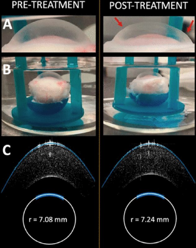 视力矫正新革命：电极“按摩”一分钟，近视或可逆转？眼睛的角膜是光线进入眼球的第一道“镜片”，其曲度决定了我们能否看清世界