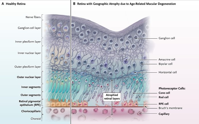 告别失明？《新英格兰医学杂志》报道视网膜植入物新进展地图样萎缩（GA）是老年黄斑变性（AMD）导致的不可逆失明主因，影响全球超500万人 