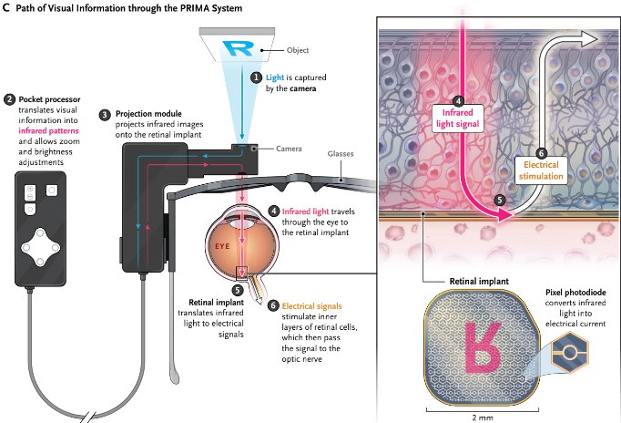 告别失明？《新英格兰医学杂志》报道视网膜植入物新进展地图样萎缩（GA）是老年黄斑变性（AMD）导致的不可逆失明主因，影响全球超500万人 