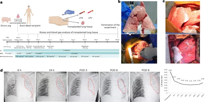 中国团队领跑世界！基因猪肺成功“植入”人体，异种移植开启新篇章近日，《自然 · 医学》发表了一项重磅研究，由广州医科大学附属第一医院何建行院士领衔的中国科学家团队，成功将一枚经基因编辑的猪肺移植到一名脑死亡受体中，并维持其功能长达 216 小时，完成了世界首例猪 - 人肺异种移植的成功报道 