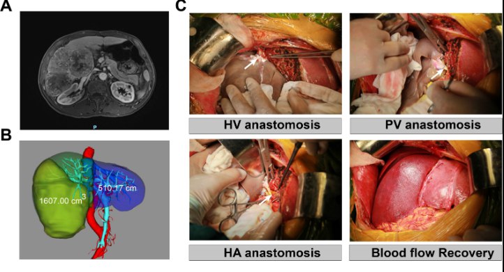 异种移植里程碑：10基因编辑猪肝“上岗”38天，助活体患者存续171天安徽医科大学第一附属医院孙倍成教授团队完成了世界首例基因编辑猪肝到活体人体的辅助移植，并于近日将成果发表于《肝脏病学杂志》 
